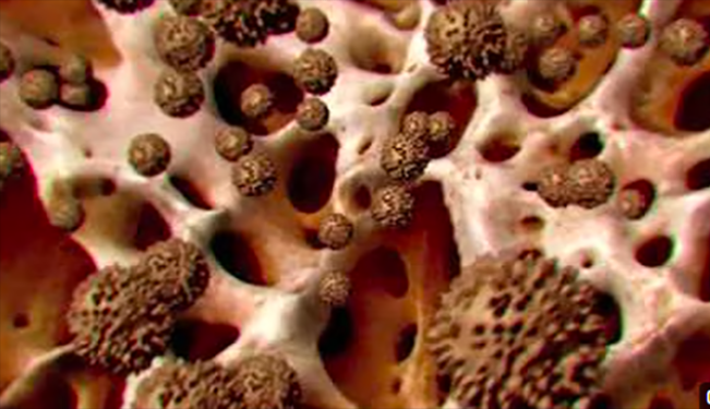 Ilustrasi/Foto:  tangkap layar YouTube American Society of Hematolog